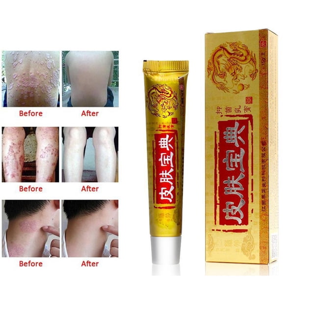 crema de medicina china para psoriasis, dermatitis, eccema, prurito, problemas de la piel, alivia la picazón de la piel, ungüento tubo de 15g importado Anggrek en empaque dorado con caracteres chinos; vista frontal de tubo y caja, acabado metálico del tubo, texto rojo vertical en la caja y paneles antes/después que muestran placas en espalda, piernas y cuello y piel más uniforme después; especificación: fungicida, contenido neto 15g.