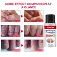 thumbnail image 3 of Esencia de eliminación de hongos en las uñas Gel líquido para uñas de manos y pies Gel de paroniquia para onicomicosis, 3 of 9