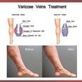 thumbnail image 3 of Parche eficaz para el alivio de las venas varicosas Cuerpo Pierna Vasculitis Flebitis Araña JShteea Cuidado Belleza, 3 of 6