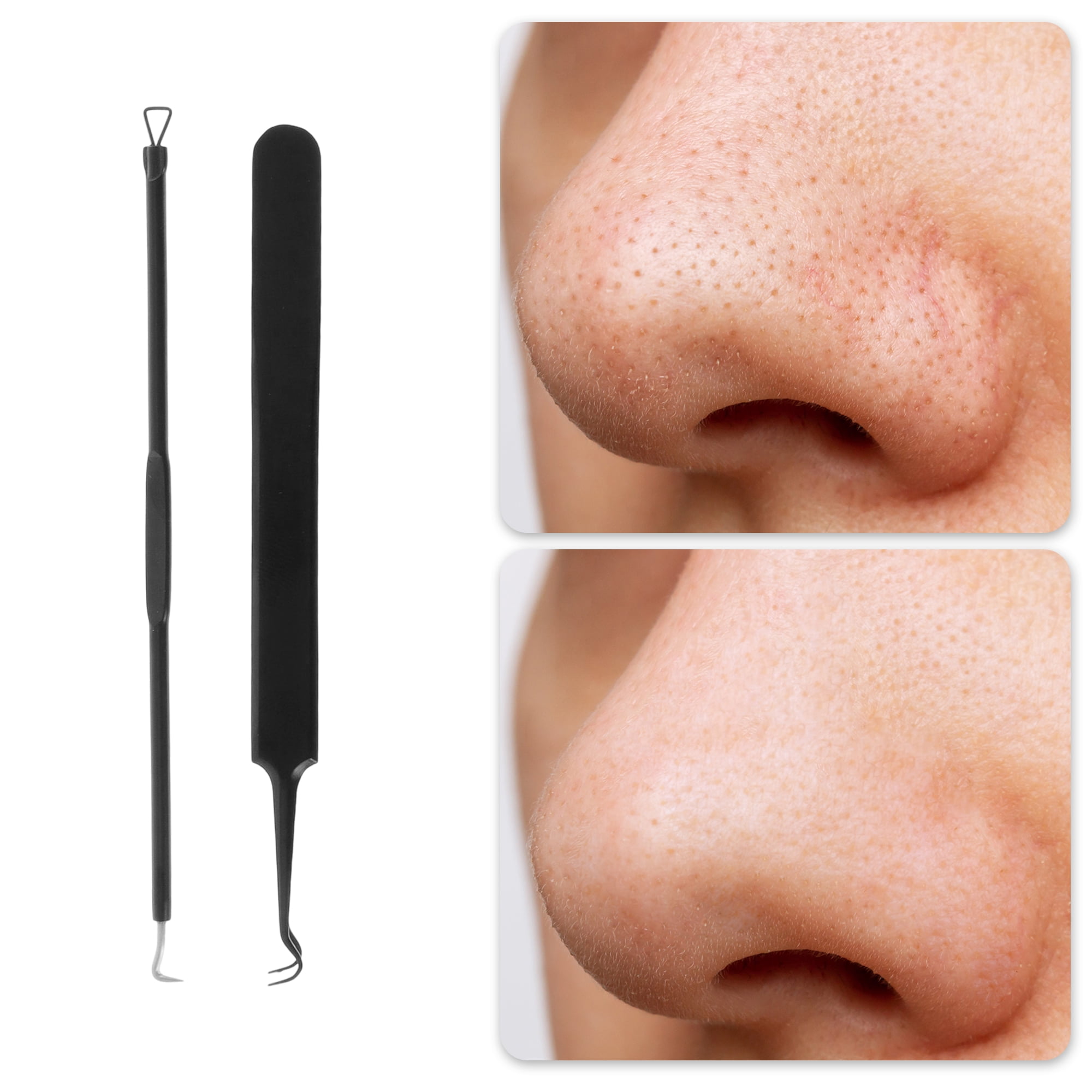 Unique Bargains Regular Pimple Extractor Tool Kit Textured Grip Black