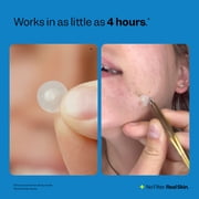 Peach Slices Acne Spot Dots, Hydrocolloid Pimple Patches, 30 Ct