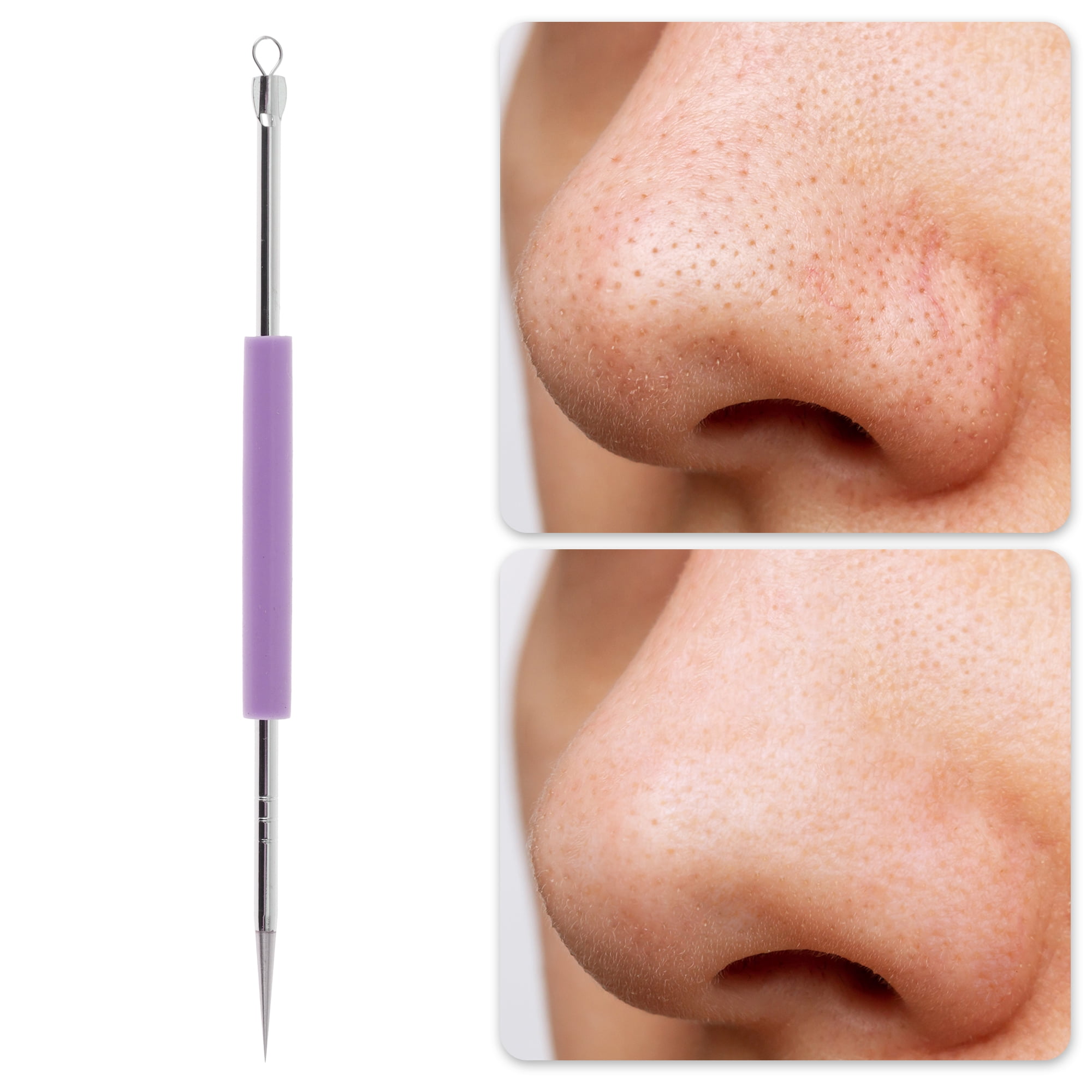 Unique Bargains Professional Durable Pimple Extractor Tool 4.92 Length 1 Pcs Purple
