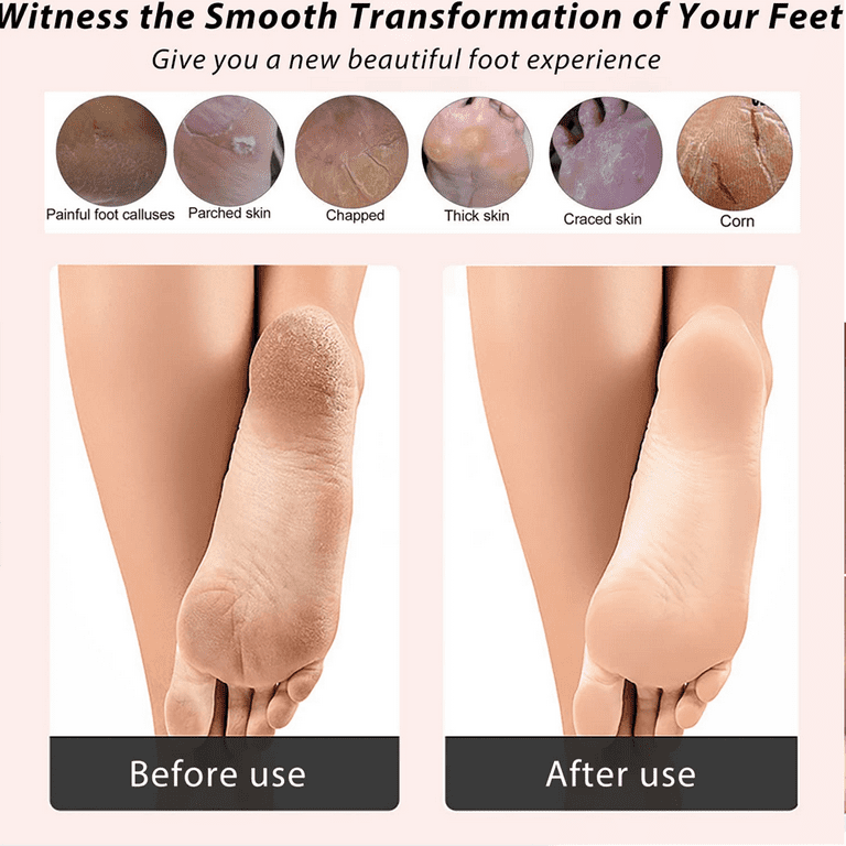 How to Remove Dead Skin From Feet Fast & Easy to Smooth Your Soles