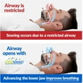 thumbnail image 3 of Anti-Snoring Mouthpiece, Stop Snoring & Sleep Better, Men's Size, Adjustable & Personalized Fit, 3 of 6
