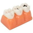 thumbnail image 4 of Modelo de patología de caries dental, dientes de caries dentales de resina, modelo de caries dental, modelo de caries diseñado a medida, 4 of 8