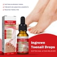 thumbnail image 3 of Aceite De Corrección De Uñas Encarnadas Gotas Para Uñas Encarnadas Cuidado De Uñas Para Uñas Encarnadas ANGGREK  Otros, 3 of 8