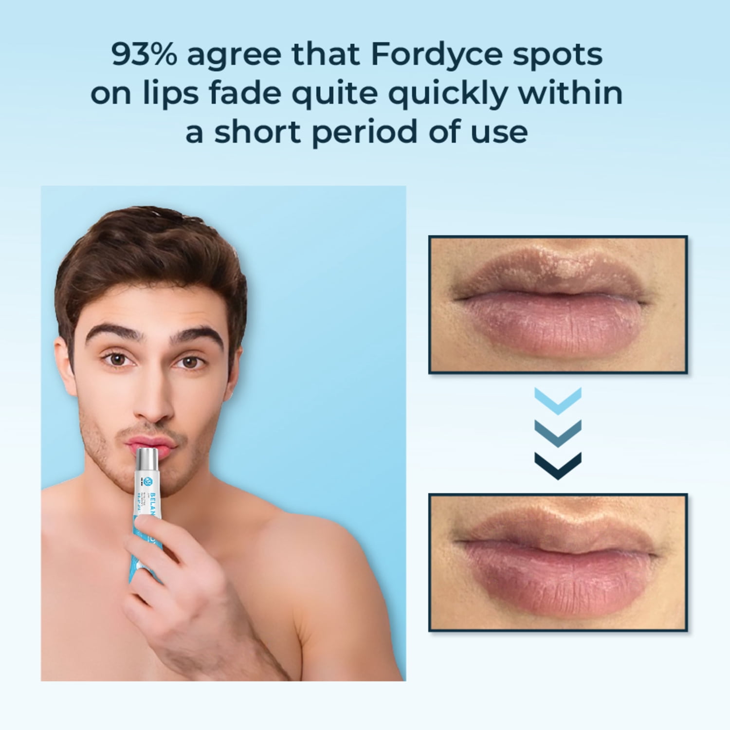 Belani Fordyce Spots Lip Cream, Hydrating Dark Lip Treatment, Fordyce Seeds 0.7 fl oz