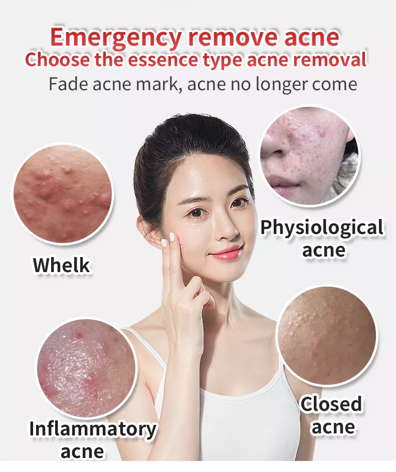 Buy Azelaic Acid Anti Acne Gel,Acne Melasma Removal, Vitamin A Fruit Acid Skin Anti Acne Pimples