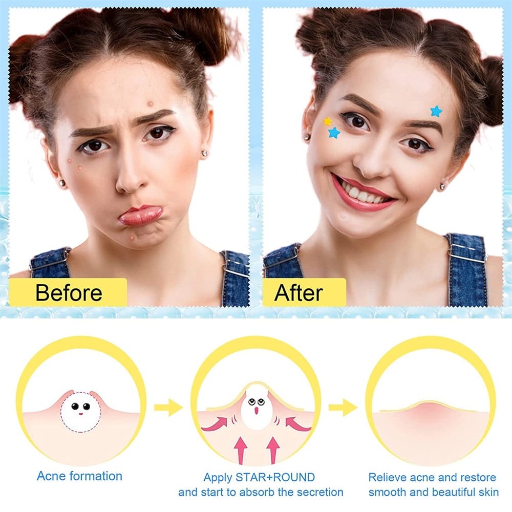 NOGIS Star Acne patch For Face,Cute Hydrocolloid Acne Patch NOGIS Star Acne patch For Face,Cute Hydrocolloid Acne Patch