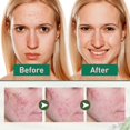 thumbnail image 3 of Jaysuing Tea Tree Oil Acne Essence Smallpox Diluting Facial Sensitive Reddish Hydrating Repair Acne Essence |, 3 of 4
