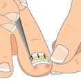thumbnail image 3 of Ingrown Toenail Pedicure Tool 10pcs/bottle Straightening Curved Bs Brace Toenails Thick Paronychia, 3 of 5