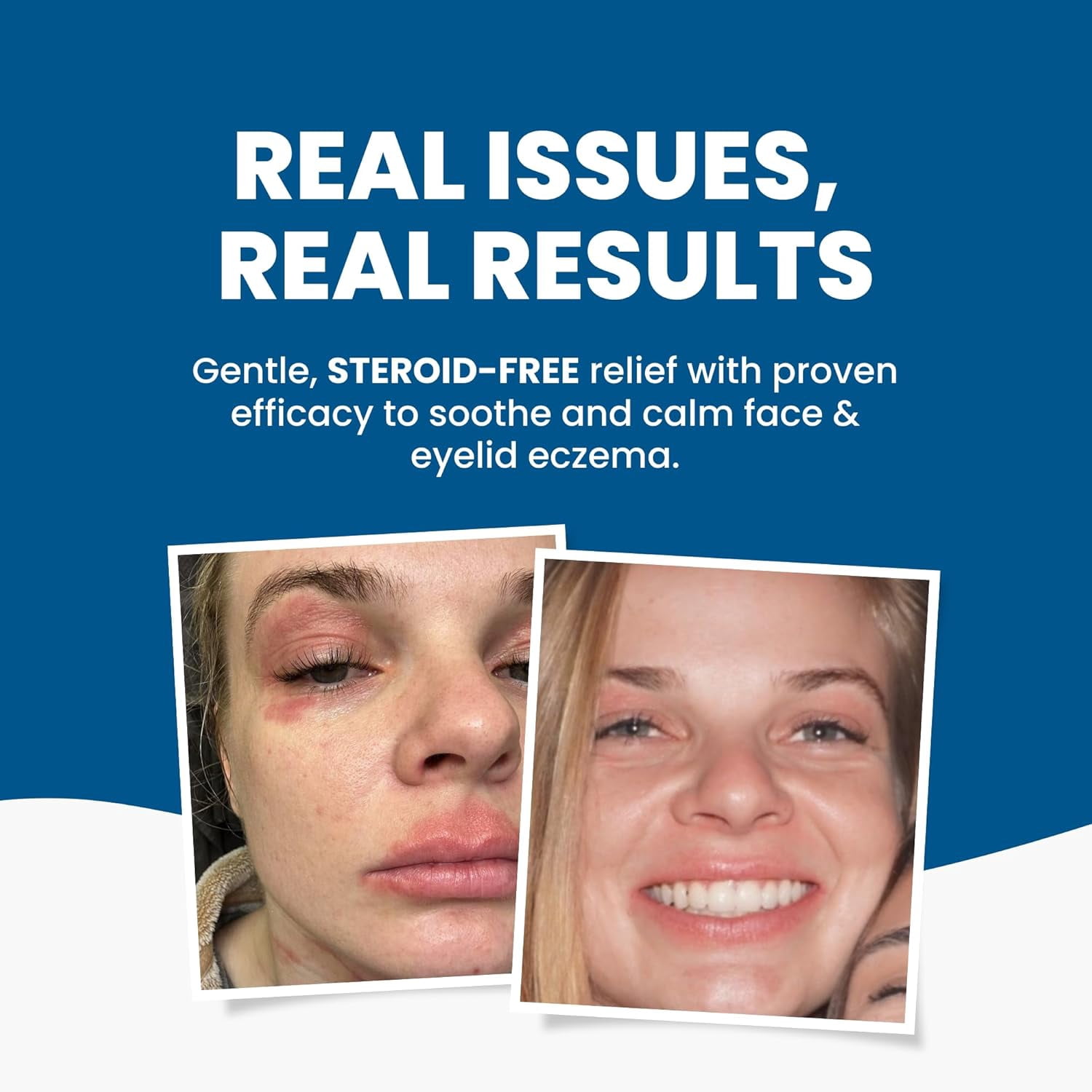 Grahams Natural Face & Eyelid Eczema Relief Kit (1.76 oz Cream & 50ml Oil)