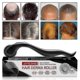 thumbnail image 1 of Hair Derma Roller 600 Titanium Micro Needles Roller Hair Regeneration Growth Scalp Massager 26-27s, 1 of 5