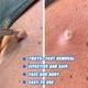 thumbnail image 3 of IBeaLee Cross border Wart Removal Liquid, Youfu Flat Liquid, Huangzi Point Mole Liquid, Chicken Eye Filament Flat Youde Removal Liquid, 3 of 5