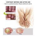 thumbnail image 3 of Gel reparador de uñas, tratamiento de hongos en las uñas de los pies, restaura las uñas amarillas quebradizas para uñas dañadas, 3 of 5