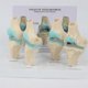 thumbnail image 3 of Knee Kit Osteoarthritis Anatomy Model with Educational Key Card 4 Stage Knee Model Orthopedic Teaching Aids, 3 of 5