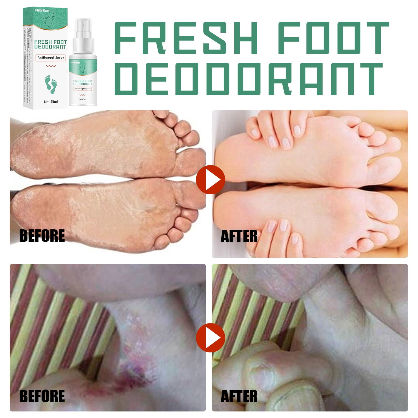 Athletes Foot Spray Antifungal Foot Fungus Treatment Extra Strength