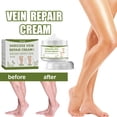 thumbnail image 2 of Crema para venas varicosas Venas varicosas & Crema calmante para piernas, removedor de varices para piernas, pies, manos, dedos de los pies, mejora xuanjing  unisex, 2 of 2