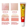 thumbnail image 4 of Crema calmante para la psoriasis y la dermatitis para una piel sana Alivio natural del eczema, 4 of 8