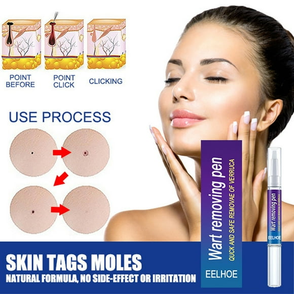 CYC 3ML Kexiu Liquid Pen Mild And Secure Solution For Skin Warts Easily Resolve Wart Issues Propagate Sound Skin Gloss
