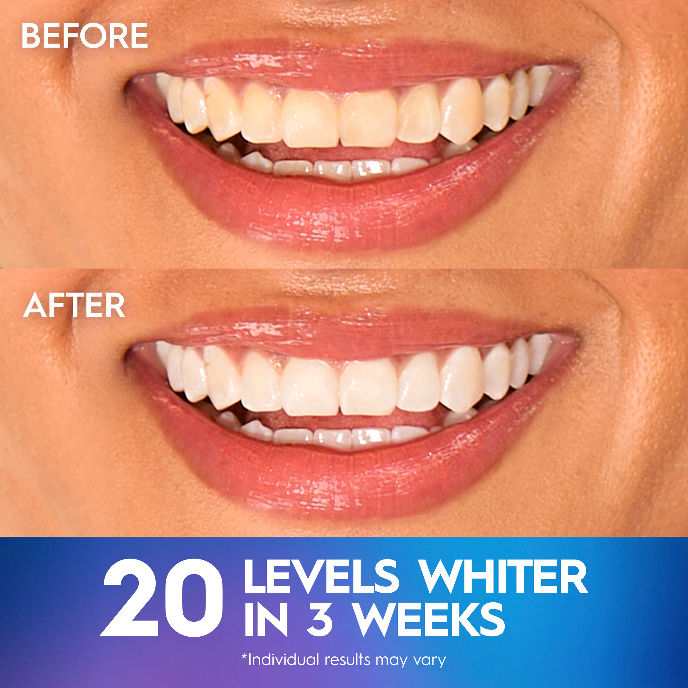 Crest 3D Whitestrips Professional White At-Home Kit, 20 Treatments photo 4