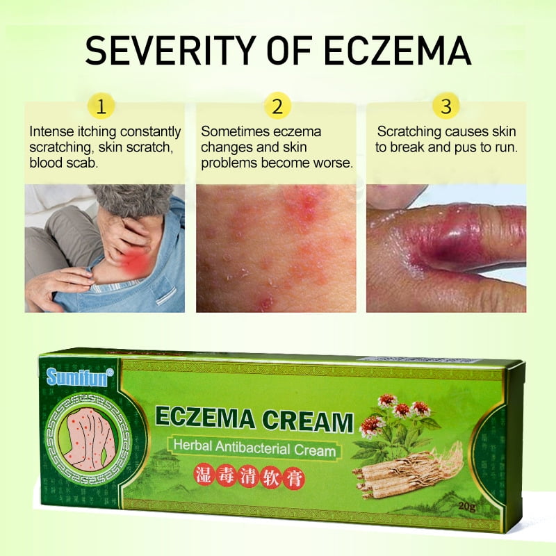 Buy Eczema Cream, Dry Skin, Eczema Treatment , Calendula Cream