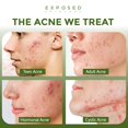 thumbnail image 2 of Kit de tratamiento para el acné Exposed Skin Care con ácido salicílico al 2,5%, 2 of 9