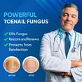 Tolnaftate Vs Undecylenic Acid For Toenail Fungus Toenail Fungus Treatment For Toenail & Finernails, 25% Undecylenic acid