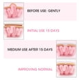 thumbnail image 4 of Hernia Belt, Umbilical Hernia Belt, 2Pcs For Children Infant Pink, 4 of 8