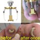 thumbnail image 4 of de herramientas para el de los pies para pedicura, correcci de as encarnadas, parches el?s para as Sunnimix corrector de uñas encarnadas, 4 of 8