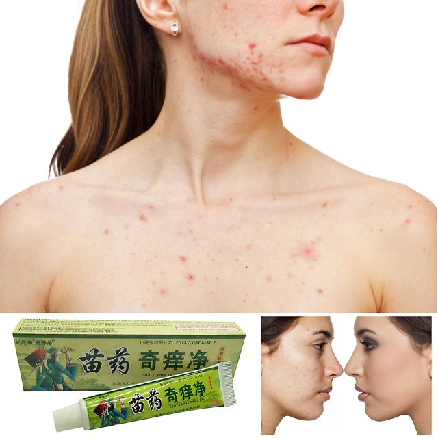 Crema facial a base de hierbas naturales, crema corporal, crema Medicinal china, crema antipicazón para uso externo