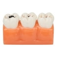 2024 New Resin Dental Caries Teeth Model 4 Times Dental Pathology 2024-new-resin-dental-caries-teeth-model-4-times-dental-pathology