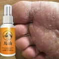 thumbnail image 3 of Spray Para Pies A Base De Hierbas Anti Hongos Alivia La Crema Beriberi Cuidado De La Piel Tratamiento Del Dedo Pie Infección Micótica Reparación De, 3 of 3