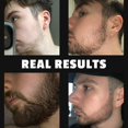 thumbnail image 4 of Beard Growth Roller - 0.5 Mm Titanium Needles - Derma Roller For Men - Matte Black Beard Roller, 4 of 5