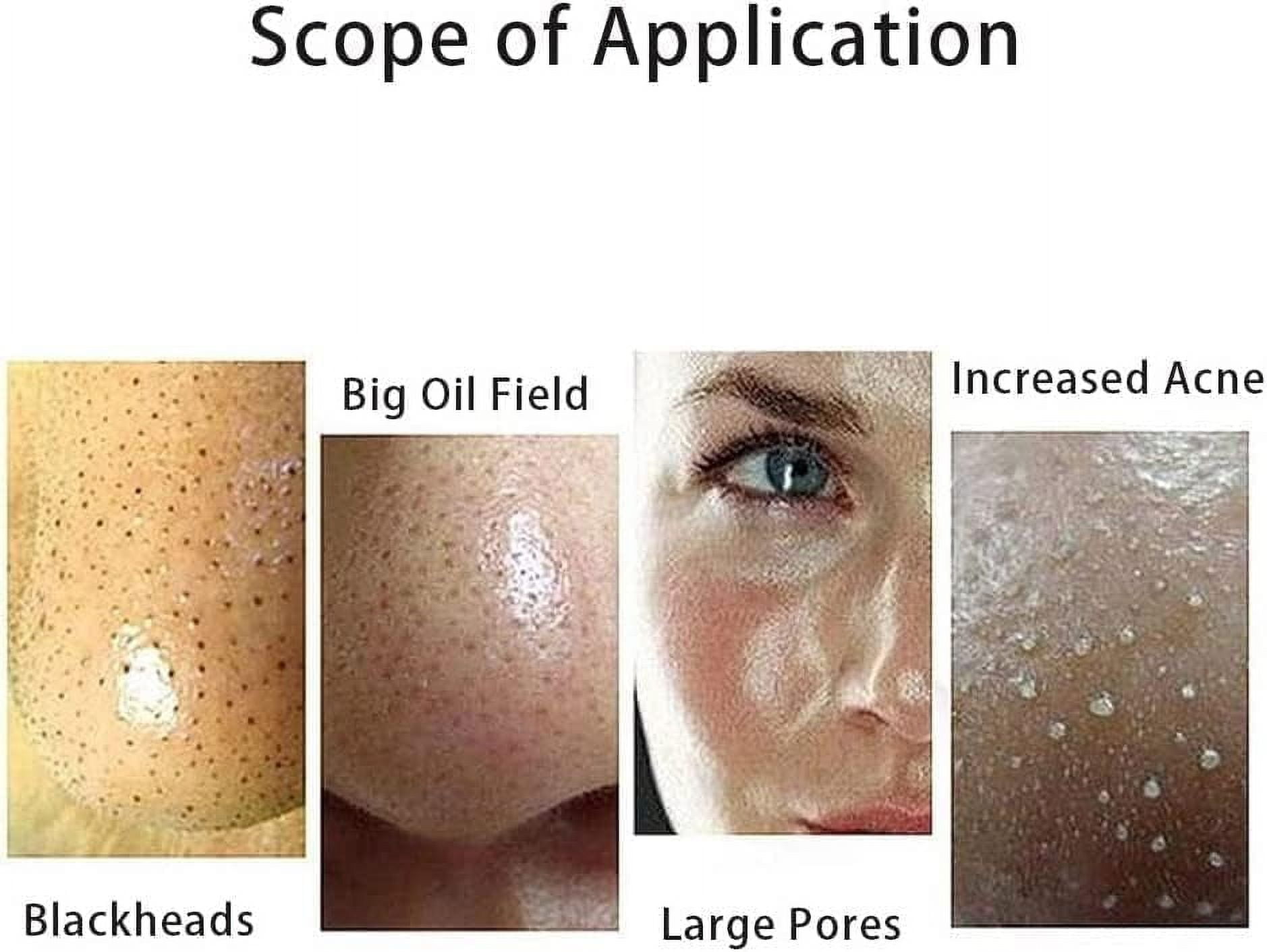 Blackhead Remover Vacuum Electric Acne Pore Remover Sucker Extractor Pimple Cleaner Blackhead Sucking Meter for Face