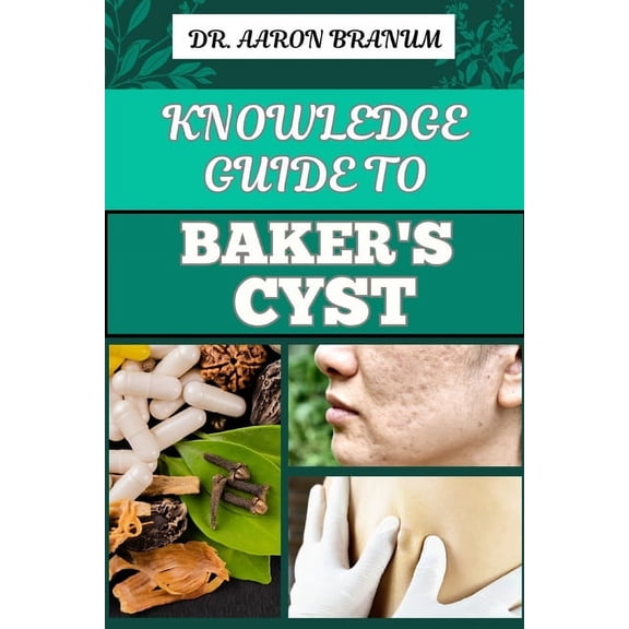 Knowledge Guide to Baker's Cyst: Essential Manual To Symptoms, Diagnosis, Treatment Options, And Prevention For Optimal , (Paperback)