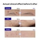 thumbnail image 3 of Tratamiento para árboles de té Spot Patch Mediheal Derma Clear, 132 parches, 3 of 8