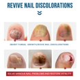 thumbnail image 4 of 2024 Best German Toenailplus NailProp Anti Paronychia Relief Nail Oil, 4 of 8