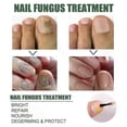 thumbnail image 3 of Extra Strong Nail Fungus Treatment, Best Nail Repair Stop Fungal Growth Effectiv, 3 of 5