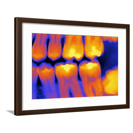 Teeth with Fillings, X-ray Framed Print Wall Art By