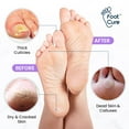 thumbnail image 3 of Foot Cure Lavender Foot Soak & Callus Remover Gel Kit - Remove Calluses with Epsom Salts, Callus Remover Gel for Dry Cracked Heels & Foot Odor, 3 of 9