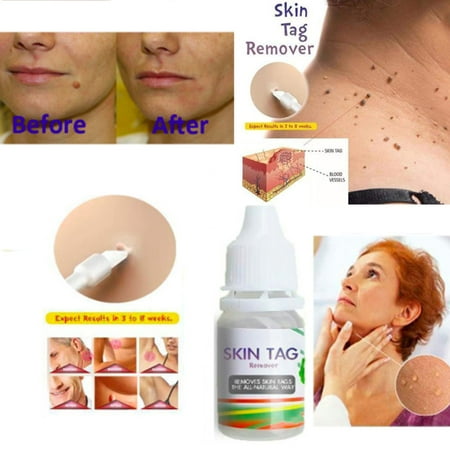 Skin Tag Remover Medical Remover Skin Tag Mole & Genital Wart (Best Medication For Genital Warts)