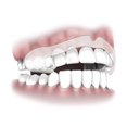 thumbnail image 2 of 10pcs Night Protector Dental Guard No More Teeth Grinding Mouthguard, 2 of 5