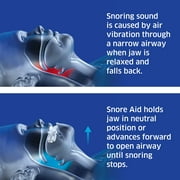 SleepRight Snore Aid – Mouthguard, FDA-Approved for Snoring, Includes Top & Bottom Trays & Case, 1 Count