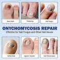 thumbnail image 5 of Toenail Fungus Patch Antiseptic Nail Repair Patches Nail Ingrown Correction Stickers for Discolored Or Damaged Nails, 5 of 5