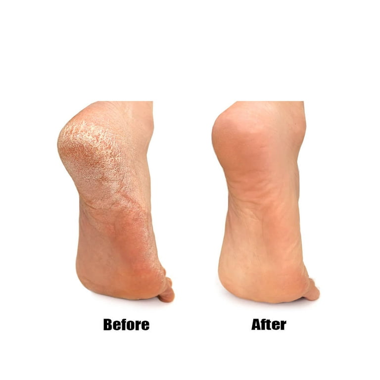 6 Pc Callus Remover Feet Hard Skin Remover Corn Shaver Pedicure Replac —  AllTopBargains
