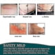 thumbnail image 5 of Elaimei Self adhesive Scar Stickers Scar Removal Patch Remove Trauma Burn Sheet New 8317095404777, 5 of 5