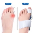 thumbnail image 1 of Corrector de Hallux Valgus ortesis juanete pulgar enderezador pies ajustador Ndcxsfigh  Cuidado Belleza, 1 of 5