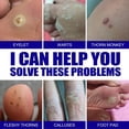 thumbnail image 5 of Pomada para eliminar verrugas, herpes genital, vulva genital, condiloma acuminado, eliminador de marcas en la piel, crema de tratamiento antibacteriano, 5 of 5