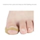 thumbnail image 5 of Pegatinas profesionales para el cuidado de los pies para una corrección sin dolor de las uñas de los pies y una pedicura saludable Solución eficaz para las uñas encarnadas, 5 of 8